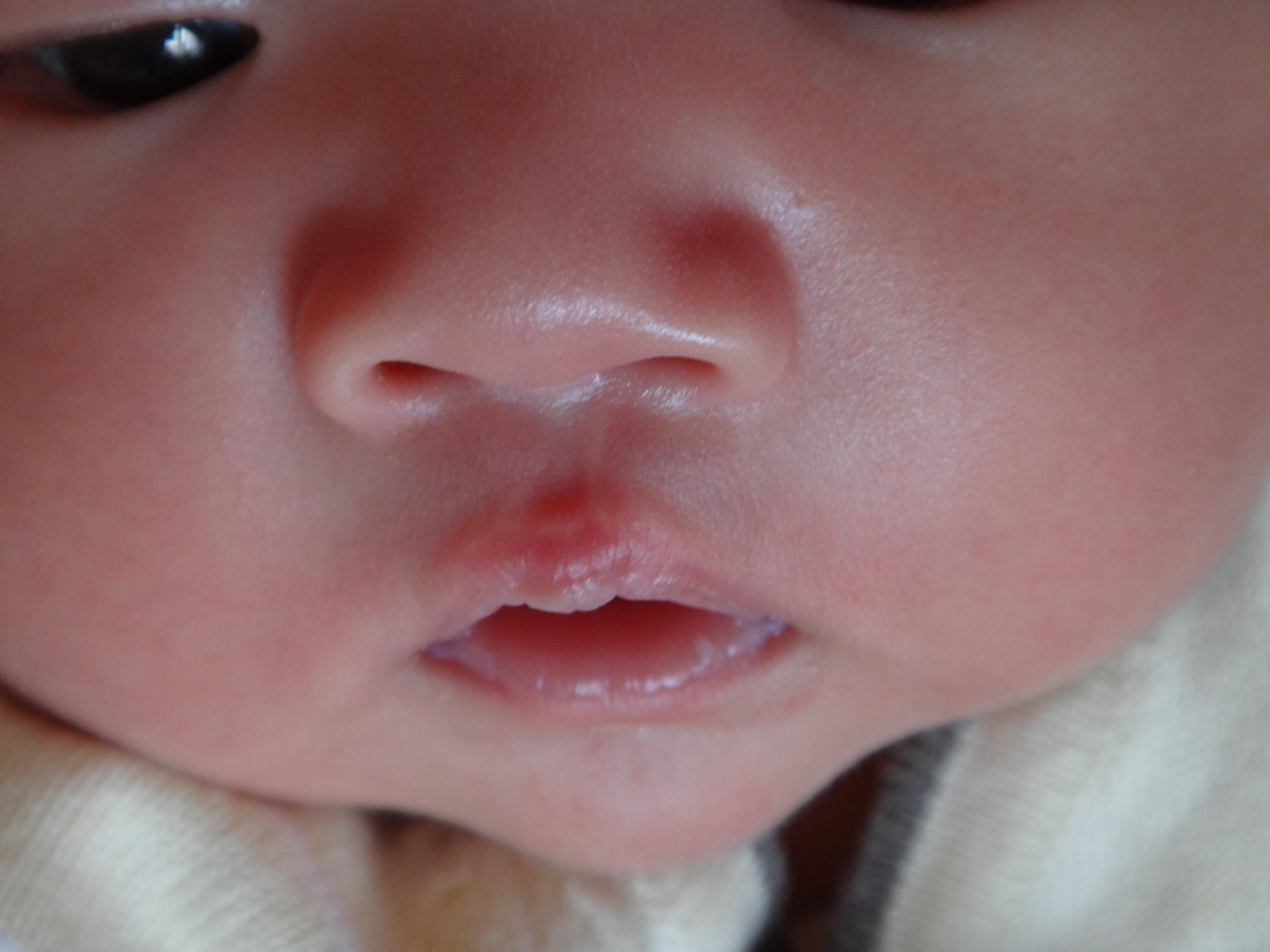 胎儿唇腭裂产前超声检查专家共识...|唇腭裂|共识|胎儿|检查|-健康界
